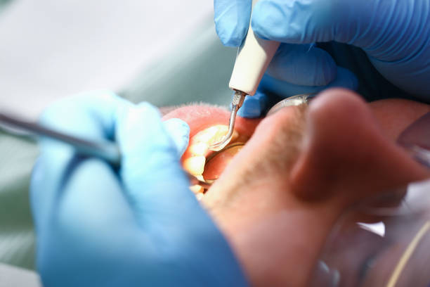 Best Emergency Tooth Extraction in Marseles, IL