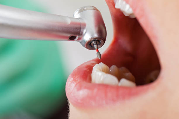 Best Emergency Tooth Extraction in Marseles, IL